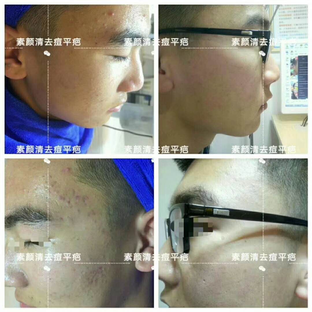 我的人生深陷痘“坑”中差点上不来